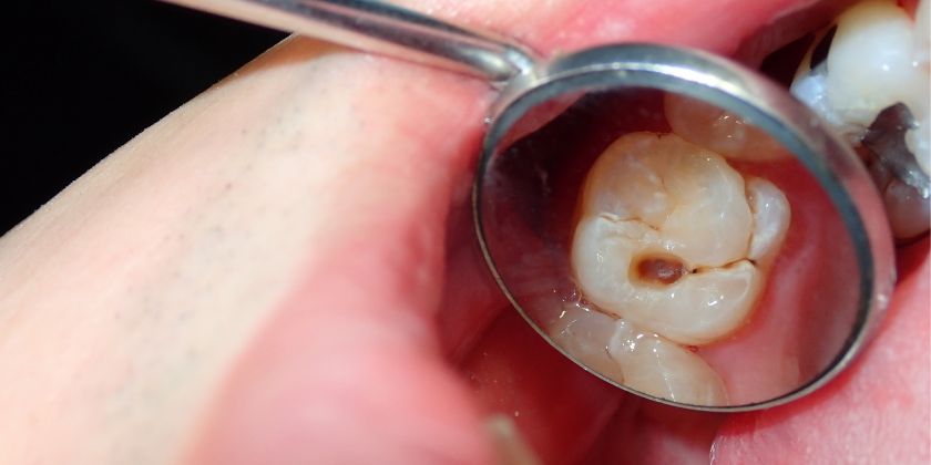 Cárie no Dente e Sensibilidade: Cuidados Essenciais