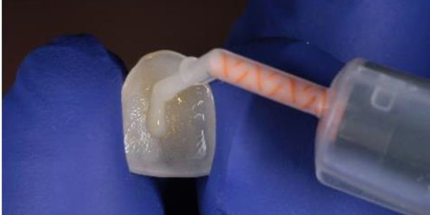 O que é Cimentação de Dente?
