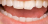 Fratura de dente: Entenda as causas e tratamentos