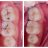 Restauração de Dente